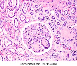 
Advanced diabetic nephropathy. Renal glomerulus showing diffuse mesangial expansion, Kimmelstiel–Wilson nodules and thickening of the Bowman's capsule basement membrane. Arteriolar hyalinosis (right) - Shutterstock ID 2171160813