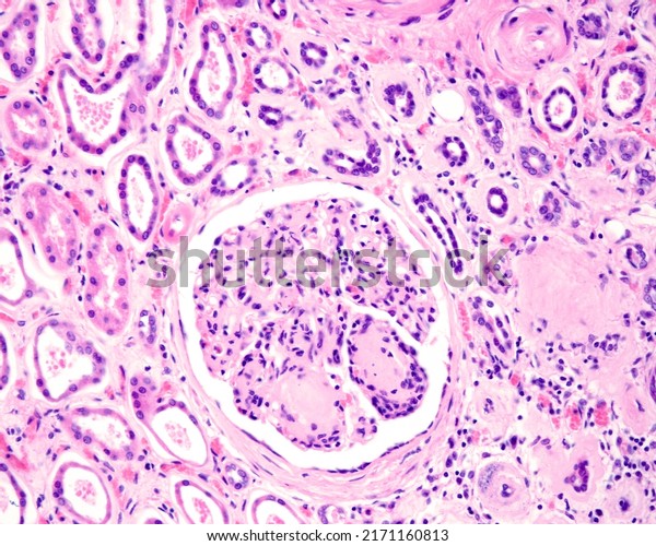 \
Advanced diabetic nephropathy. Renal glomerulus\
showing diffuse mesangial expansion, Kimmelstiel–Wilson nodules and\
thickening of the Bowman\'s capsule basement membrane. Arteriolar\
hyalinosis (right)