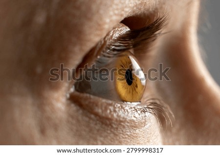 Advanced keratoconus eye disease macro profile view.