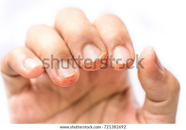 Advanced Stage Dyshidrosis On Fingerscracked Peeling Stock Photo (Edit ...