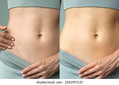 An advertisement for a cream, ointment or gel for removing scars after surgery and cuts. Supports skin renewal. Appendicitis scar before and after on a young woman