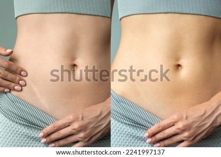 An advertisement for a cream, ointment or gel for removing scars after surgery and cuts. Supports skin renewal. Appendicitis scar before and after on a young woman