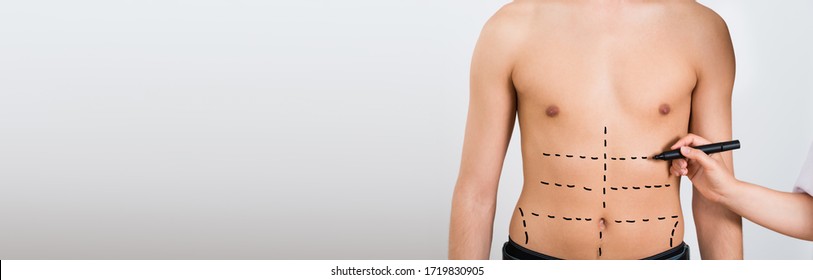 Aesthetic Plastic Surgery. Male Liposuction. Body Abdomen