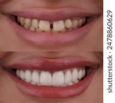 Aesthetic smile design in dental dentistry and cosmetic dentistry. Smile makeover with E-Max laminate veneers and zirconium dental crowns. Dental before and after. Glass ceramic light-transmitting