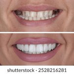 Aesthetic smile design treatment in dental dentistry. Dental treatment with laminate veneers, dental implants, and porcelain crowns. Smile makeover and dental before and after. 

