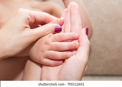 After Effects Of Coxsackie Virus: Onychomadesis (nail Shedding) In A 3-year-old Child, 1 Month After The Hand, Foot And Mouth Disease With Coxsackie Viral Infection