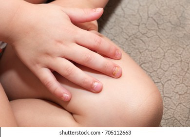 After Effects Of Coxsackie Virus: Onychomadesis (nail Shedding) In A 3-year-old Child, 1 Month After The Hand, Foot And Mouth Disease With Coxsackie Viral Infection