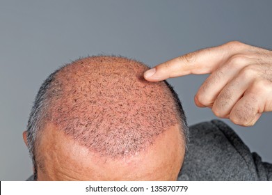 After Hair Transplant Surgery