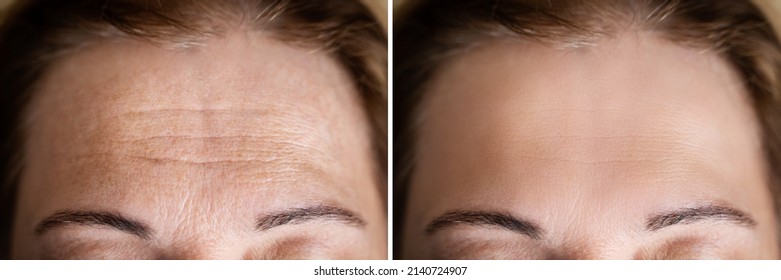 Age Anti Forehead Wrinkles Treatment Before And After