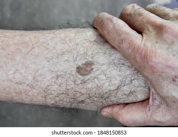 Dark Spots On Legs High Res Stock Images Shutterstock