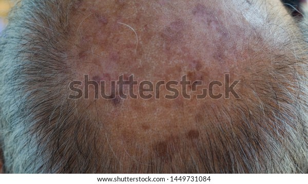 Age Spots Front Bald Head Old Stock Photo Edit Now 1449731084