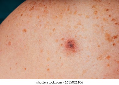 Lentigo Melanoma High Res Stock Images Shutterstock