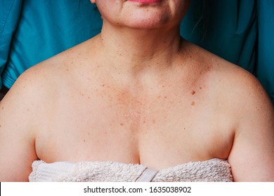 Age Spots, Moles And Freckles On The Neck And Chest Of An Older Woman. Spots On The Body. Decollete Area Neckline Of An Elderly Woman