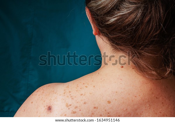 Age Spots Moles Freckles On Back : Foto De Stock (editar Ahora) 1634951146