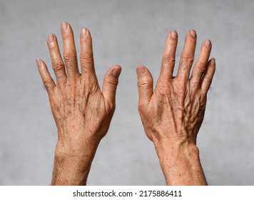 Age spots on hands of Asian elder man. They are brown, gray, or black spots and also called liver spots, senile lentigo, solar lentigines, or sun spots. - Shutterstock ID 2175886411