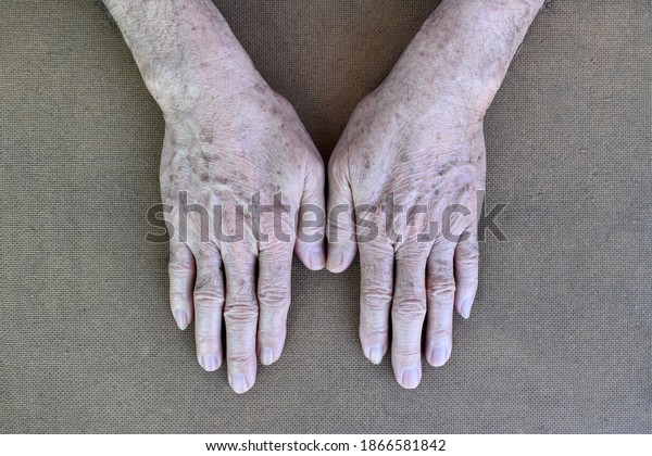 Age Spots On Hands Asian Elder Stock Photo Edit Now