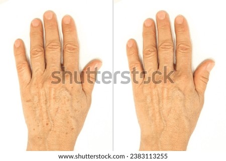 Age spots on the hands before and after removal using a lightening whitening cream. Rejuvenation procedure, laser treatment, peeling. Liver spots, lentigo, sun spots. Cosmetology and beauty concept