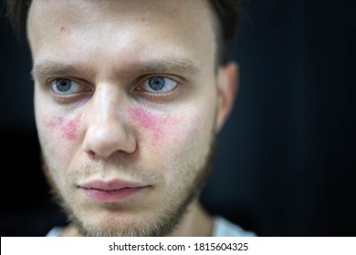 Age Spots Of Redness On The Face, A Young Man Is Sick Systemic Lupus Erythematosus