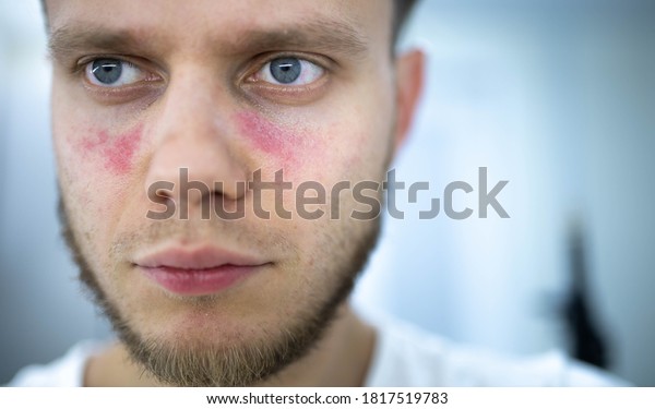 age spots of redness on the face, a young\
man is sick systemic lupus\
erythematosus