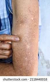 Age Spots And White Patches On Arm Of Asian Elder Man. They Are Brown, Gray, Or Black Spots And Also Called Liver Spots, Senile Lentigo, Solar Lentigines, Or Sun Spots.