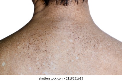 Age spots and white patches on upper back of Asian elder man. They are brown, gray, or black spots and also called liver spots, senile lentigo, solar lentigines, or sun spots. - Shutterstock ID 2119231613