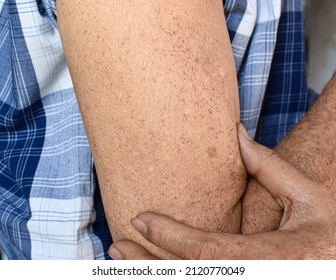 Age spots and white patches on arm of Asian elder man. They are brown, gray, or black spots and also called liver spots, senile lentigo, solar lentigines, or sun spots. - Shutterstock ID 2120770049