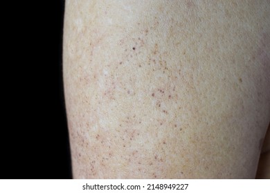 Age Spots And White Patches On Arm Of Asian Elder Man. They Are Brown, Gray, Or Black Spots And Also Called Liver Spots, Senile Lentigo, Solar Lentigines, Or Sun Spots.