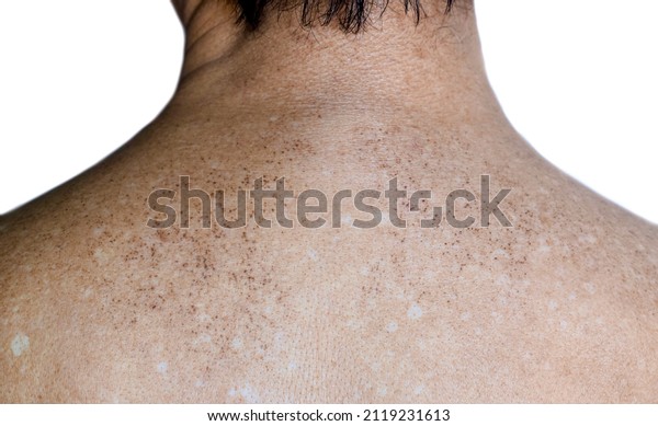 Age spots and\
white patches on upper back of Asian elder man. They are brown,\
gray, or black spots and also called liver spots, senile lentigo,\
solar lentigines, or sun\
spots.