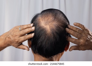 An Aged Indian Man Showing His Hair Fall Back Facing On White Background