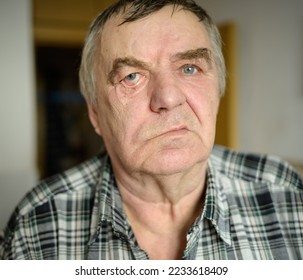 Aged man with facial nerve paralysis, Bell's palsy.