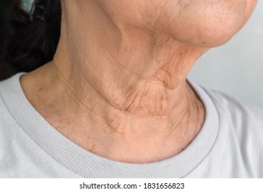 Aging Skin Folds Or Skin Creases Or Wrinkles At Neck Of Southeast Asian, Chinese Elderly Woman.