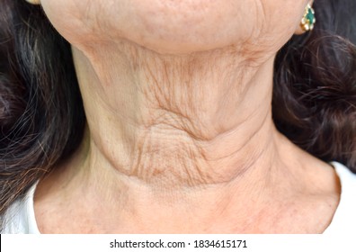 Aging Skin Folds Or Skin Creases Or Wrinkles At Neck Of Southeast Asian, Chinese Elderly Woman. Front View.