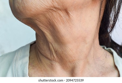 Aging Skin Folds Or Skin Creases Or Wrinkles At Neck Of Southeast Asian, Chinese Old Woman.