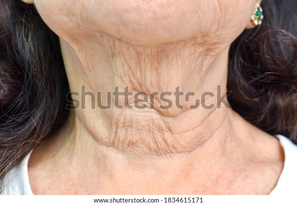 Aging skin folds or\
skin creases or wrinkles at neck of Southeast Asian, Chinese\
elderly woman. Front\
view.