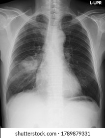 Ahteroposterior(AP) ChestX-ray Image, A Cas Of Right Lung Nodule, 68 Year Old Asian Male. (L-UPR = Left Upright)