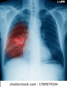 Ahteroposterior(AP) ChestX-ray Image, A Cas Of Right Lung Nodule, 68 Year Old Asian Male.