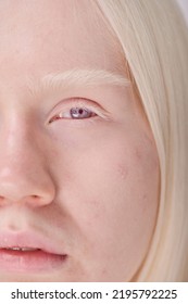 Albino Girl With Blue Eyes