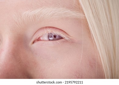 Albino Woman With Blue Eyes