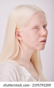 Albino Woman With Unusual Appearance