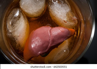 Alcoholic Liver Damage And Cirrhosis Concept With A Liver In A Glass Of Alcohol. Cirrhosis Is Most Commonly Caused By Alcoholism, Hepatitis B Or C Or Non-alcoholic Fatty Liver Disease