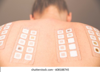 Alergy patch test on the back of a young woman