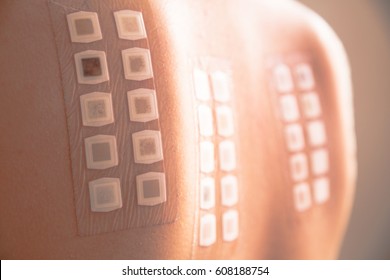 Alergy patch test on the back of a young woman