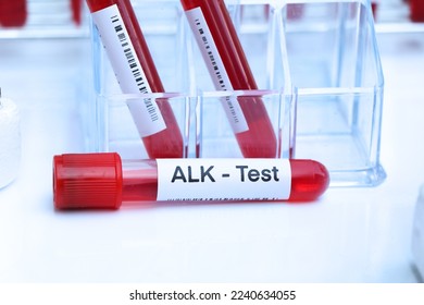 ALK test to look for abnormalities from blood,  blood sample to analyze in the laboratory, blood in test tube