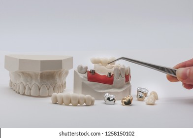 All Zirconia and Metal Crown with Implant Abutment