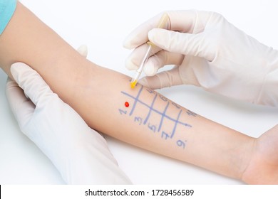 Allergen Test On Hand. Child Undergoing Procedure Of Allergen Skin Test In Clinic.