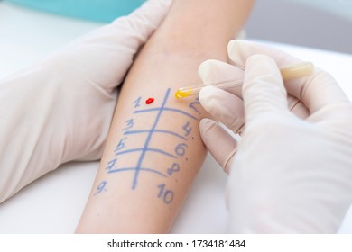 Allergen Test On Hand. Procedure Of Allergen Skin Test In Clinic.