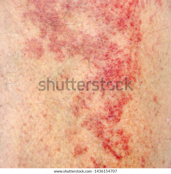 Allergic Contact Dermatitis Shin After Contact Stock Photo 1436154707 ...