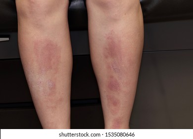 atopic dermatitis pictures on legs)