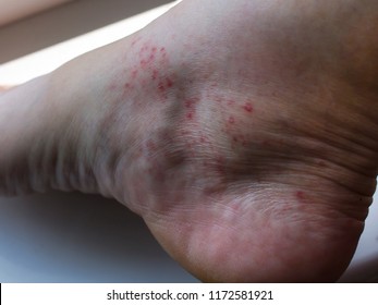 Chronic Venous Ulcer Lipodermatosclerosis Stock Photo (Edit Now) 779816089