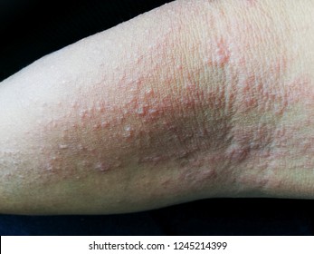 Allergic Rash Arm Stock Photo (edit Now) 1245214399